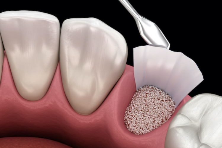 Bone Grafting